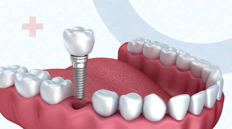 Имплантация зубов