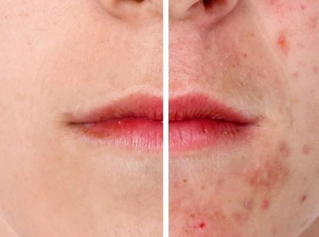 Лечение угревой сыпи