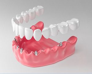 Протезирование зубов, виды, этапы процедуры и показания к лечению