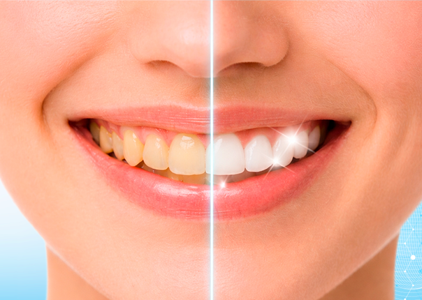 Профессиональное отбеливание зубов Zoom 4