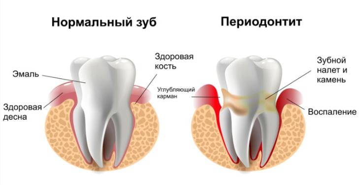 Периодонтит зуба: как и где правильно лечить в подмосковье
