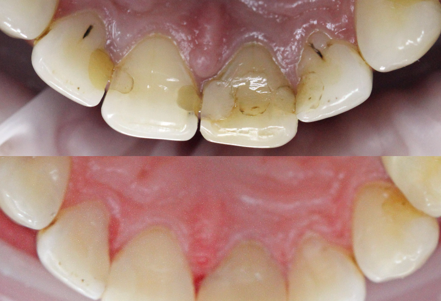Зубной кариес: как лечить самую распространенную болезнь полости рта